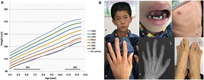 De Novo Mutation of Paternal IGF2 Gene Causing Silver–Russell Syndrome in a Sporadic Patient